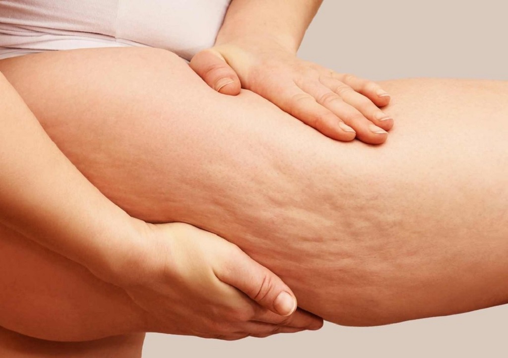 Fashion Secrets to Minimize the Appearance of Cellulite